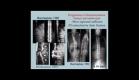 Progression of instrumentation. Thoracic and lumbar spine...