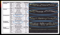 Depth of Anaesthesia Monitoring: Practical Examples...