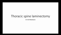Thoracic Spine Laminectomy...