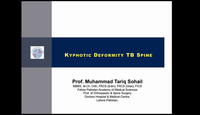 Kyphotic deformity of TB spine...