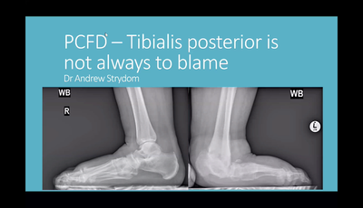 PCFD - Tibialis Posterior Is Not Always To Blame...
