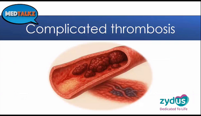 Q and A - Complicated Thrombos...